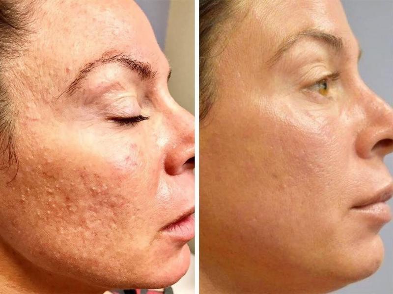 Microneedling Anti-Aging Zug Cham Luzern