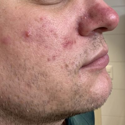 Rosacea & Akne Zug Luzern Cham