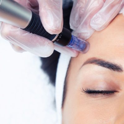 Microneedling Anti-Aging Acne Rosacia Zug Luzern Cham